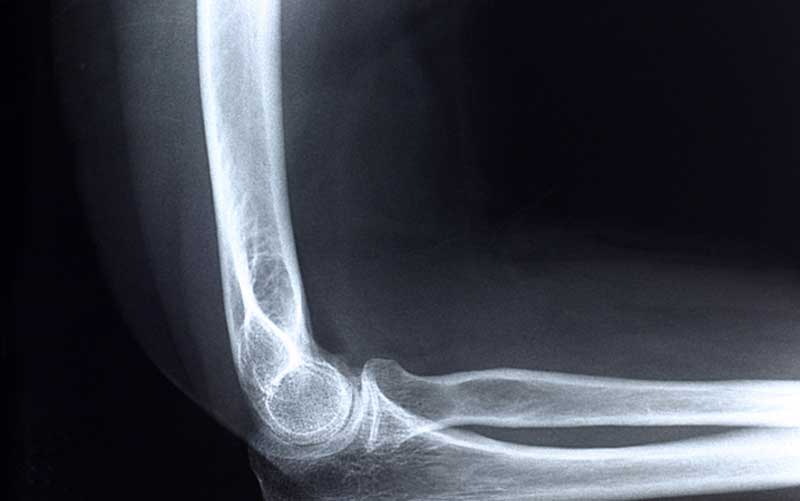 Irish radiographer mistook knee for an elbow, inquiry hears ...